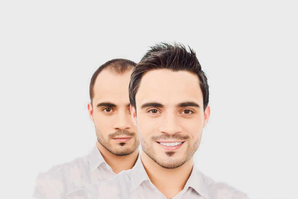 Haartransplantation in der Türkei / Antalya Kosten