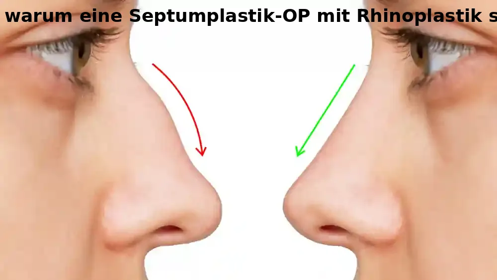 5 Redenen van Septoplasty met Rinoplastiek combinatie ...