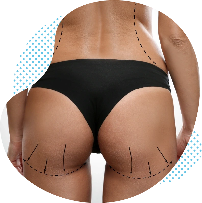 Brazilian Butt Lift BBL Türkei Antalya