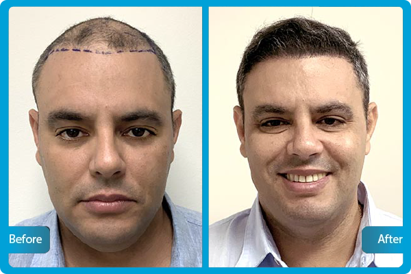 Saphir FUE Haartransplantation Türkei – Vorher-Nachher-Bilder