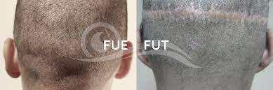 FUE und FUT Haartransplantation – der Vergleich