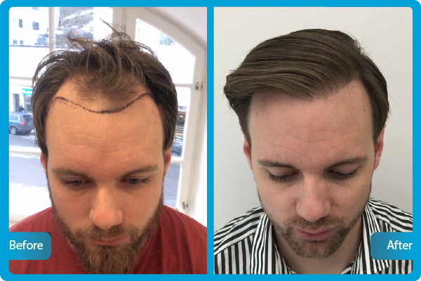 Haartransplantation Türkei Vorher Nachher​
