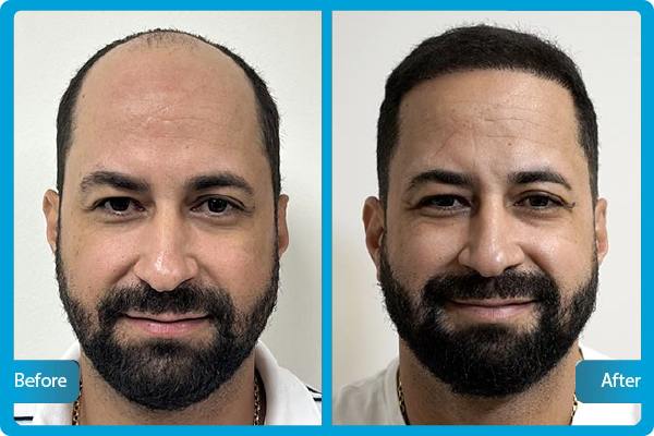 Haartransplantation Türkei Vorher Nachher​