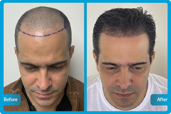 Haartransplantation Türkei Vorher Nachher​