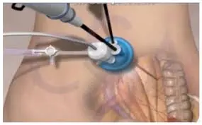 Magenverkleinerung ohne Narbe 1 SILS-Methode (Single-Incision Laparoscopic Surgery) Magenverkleinerung ohne Narbe
