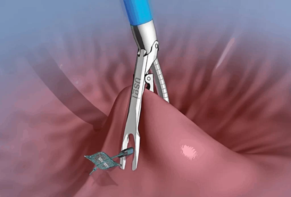 Magenverkleinerung ohne Narbe 4 Adipositas-Chirurgie ohne Narbe – POSE-Methode narbenlose narbenfreie