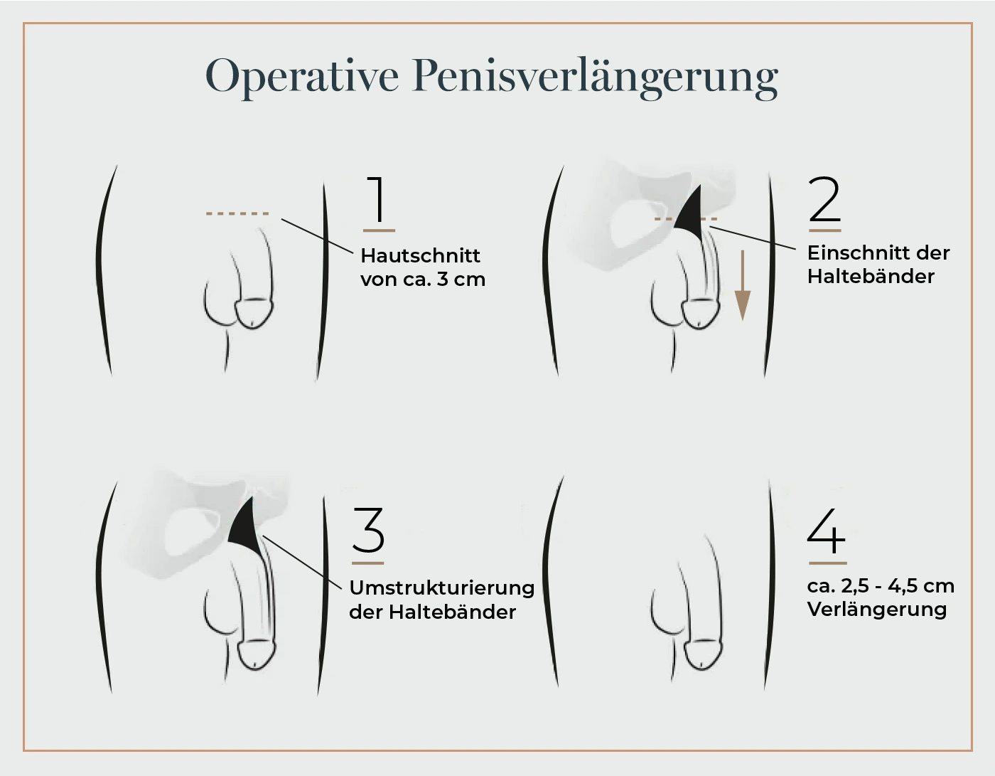 Penisvergrößerung Türkei: Penisverlängerung mit Verdickung