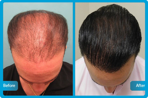 Die Saphir-FUE-Eigenhaartransplantation Türkei – Vorher-Nachher-Bilder