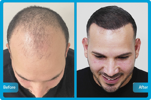 Saphir-FUE-Haartransplantation Türkei – Vorher-Nachher-Fotos