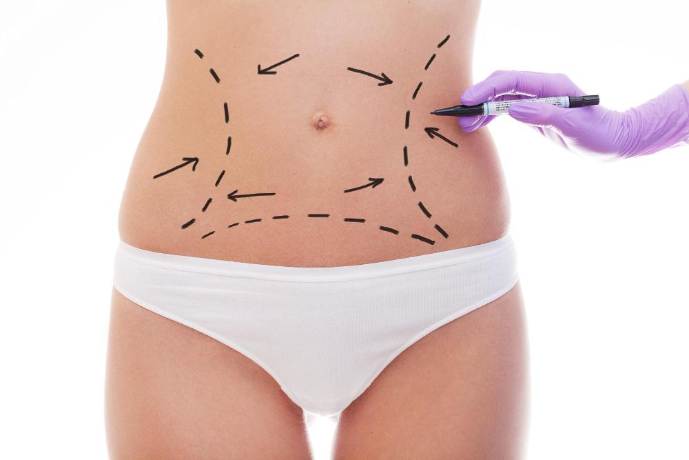 Fettabsaugung Liposuktion türkei antalya Kosten preise