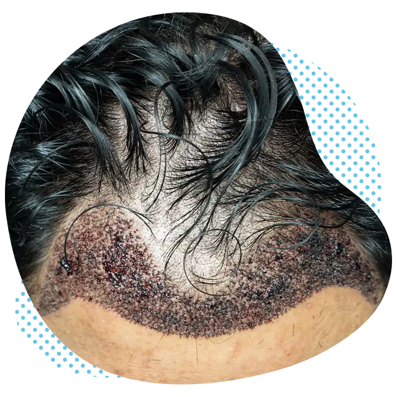 dhi-haartransplantation