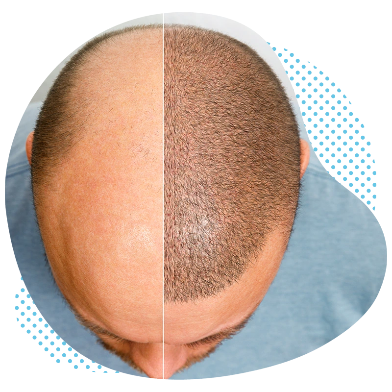haartransplantation türkei kosten