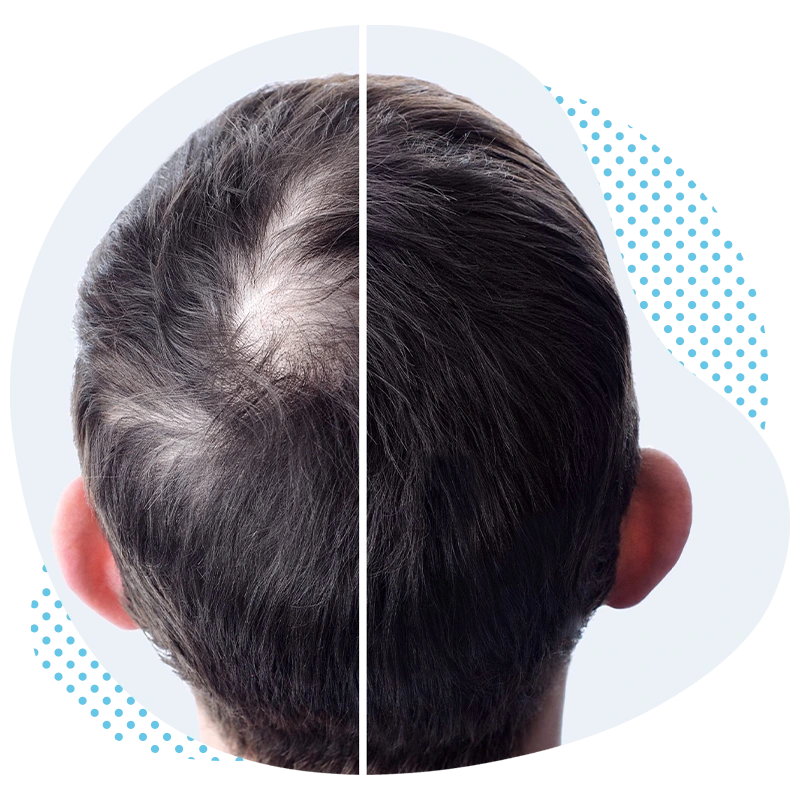 hair-loss-turkey