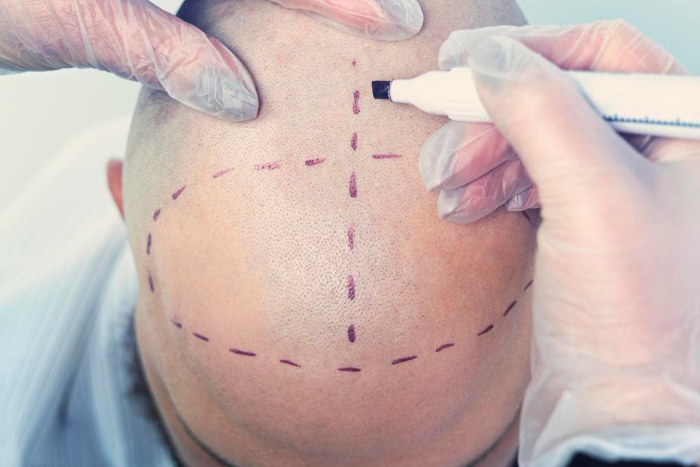 was-ist-eine-haartransplantation/