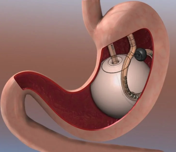 Magenverkleinerung ohne Narbe 3 Narbenfreie Adipositas Chirurgie – Magenballon