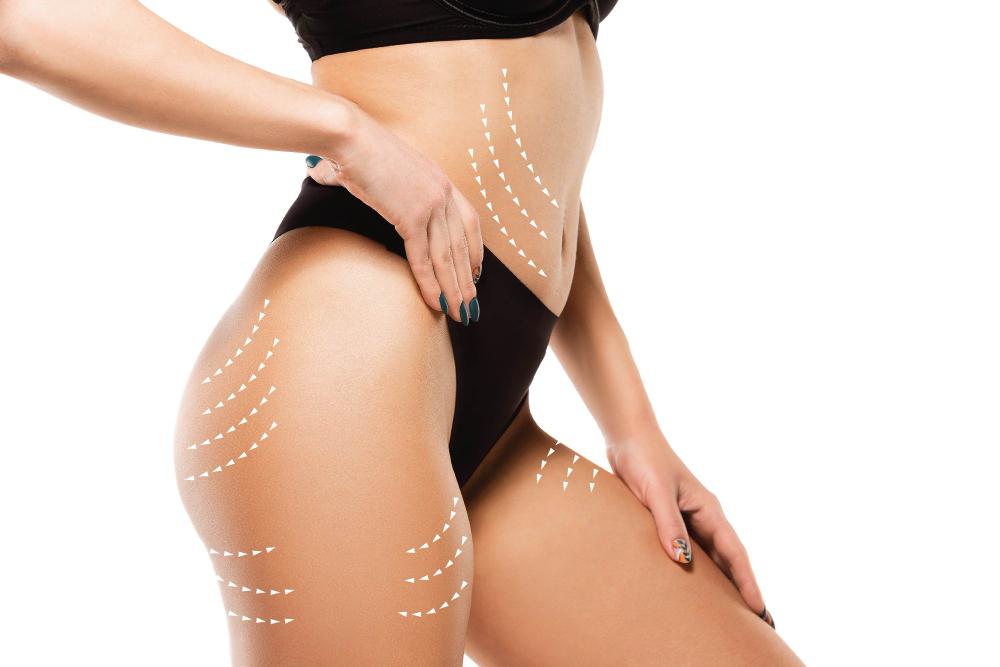 surgery-procedure-liposuction Schönheits-OP türkei antalya kosten
