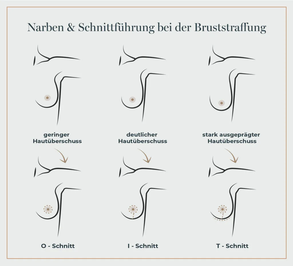 Narbenbildung und Heilung bei Bruststraffung: